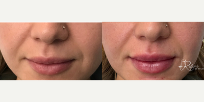 35-44 year old woman treated with Lip Fillers, Restylane Kysse - This Before & After showcases a patient who received the Signature Tulsi Lips treatment at Refine by Tulsi. The patients lips are now fuller, more hydrated, and perfectly contoured for a naturally plump look.This treatment involved: Carefully enhancing lip volume while maintaining a balanced, natural appearance. Defining the lip borders for smooth, symmetrical results.The results are subtle yet transformative, leaving the patient with beautifully enhanced lips that complement their natural features. Dr. Tulsi Kotechas signature technique focuses on precision and artistry, ensuring a natural yet impactful result every time.