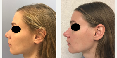 25-34 year old woman treated with Forehead Reduction - This is a young lady who desired forehead feminization (brow bone reduction).