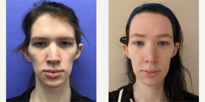 Patient treated with Rhinoplasty, Septoplasty - Septorhinoplasty (closed) with Cartilage Grafts and Weirs - 25 to 34 year-old female patient is 1 year post-op from Facial Feminization surgery. Her procedures included: Forehead Lift, Hairline Lowering, Supra Orbital Bone Reduction and Contour, Septorhinoplasty (closed) with Cartilage Grafts and Weirs, Chin Reduction and Contour, Soft Tissue to Nasolabial Folds, and Thyroid Cartilage Shave.