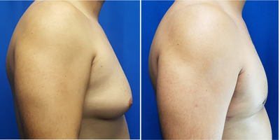 35-44 year old man treated with Gynecomastia Surgery - 39 year old male who complained of large breasts with the right being larger than the left. He had a male breast reduction for his gynecomastia. The incision was through the inferior areola. His postoperative photo is 7 weeks after surgery. His height is 5 feet 9 inches and weight is 190 lbs. The right side had 138 grams removed and the left side had 94 grams removed.