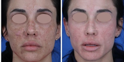 35-44 year old woman treated with Accutane, Chemical Peel, YAG Laser - 35-44 year old woman treated with Medical Grade Topicals, Accutane, Chemical Peel, & Laser