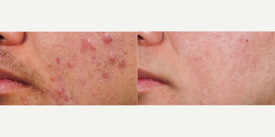 Man treated with AviClear - Are you tired of battling stubborn acne? Worried about the impact it's having on your confidence?