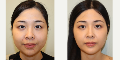 25-34 year old woman treated with Asian Rhinoplasty, Rhinoplasty, Genioplasty, Cheekbone Reduction, Buccal Fat Removal - Augmentation rhinoplasty with patients own diced cartilage and fascia (DCF Graft)