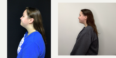 25-34 year old woman treated with Skin Tightening - Evoke