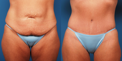 40 - 50 Year Old Female - Surgical Procedure: Abdominoplasty with hip plasty and liposuction of the medial and lateral thighs. This patient desired correction of abdomen and thighs after losing 90 pounds through diet and exercise.