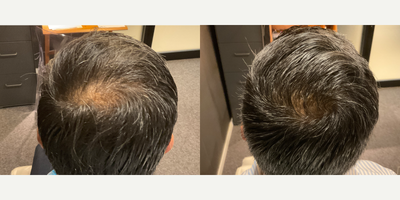 45-54 year old man treated with PRP for Hair Loss - This patient in his early 50s had been experiencing 2 years of thinning and shedding at the vertex of the scalp with only partial response to topical minoxidil. Treatment was initiated with oral minoxidil and three sessions of platelet rich fibrin matrix at one month intervals, followed by maintenance treatments every three months.
