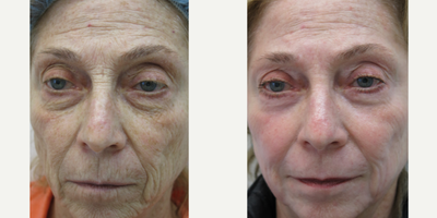 65-74 year old woman treated with Chemical Peel - Customized Chemical Peel