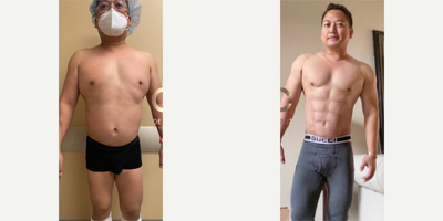 45-54 year old man treated with Abdominal Etching - Hi-Def Liposuction in a male patient using VASER liposuction of the abdomen, flanks, back and arms, with use of J-plasma/RENUVION. Fat transfer to the deltoids and pectorals muscle was also performed.