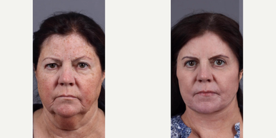 Woman treated with Facial Fat Transfer - Facial Rejuvenation Transformation.Dr. Marotta performed a Deep Plane Face and Neck Lift and Upper and Lower Blepharoplasty with Fat Injections. She also had a post procedure laser ThreeforMe treatment.