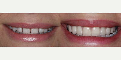 35-44 year old woman treated with Durathin Veneers - This patient did not like her smile because of the gaps between her teeth. She simply just wanted to close the spaces with Invisalign. I brought to her attention that not only were there gaps, but also her teeth were small and narrow; the size and space distribution was not appropriate according to my cosmetic principles and guidelines. I proposed to the patient I would be happy to do Invisalign if that was what she wanted, but I was concerned that she would still be unhappy with her smile. Instead of jumping into treatment, I showed her what was possible before making any commitment. I created an esthetic prototype and did a trial smile preview for her, directly on her teeth with temporary composite, in a matter of minutes with no anesthesia. She loved it! And the beauty of it was that with good communication, collaboration and planning with my laboratory technician, we determined that No-prep veneers were absolutely appropriate. Her case required NO drilling and NO anesthesia.