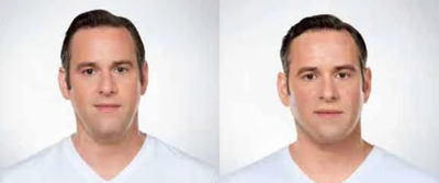 Man treated with Kybella - Man treated with Kybella to chin area, shown before and after 6 treatments.