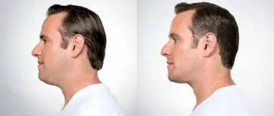 Man treated with Kybella - Man treated with Kybella to chin area, shown before and after 6 treatments.
