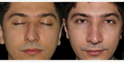 Man treated with Sinus Surgery - Blocked Nose
