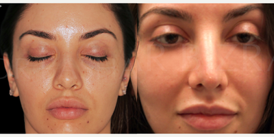 Woman treated with Sinus Surgery - Blocked Nose