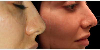 Woman treated with Sinus Surgery - Blocked Nose