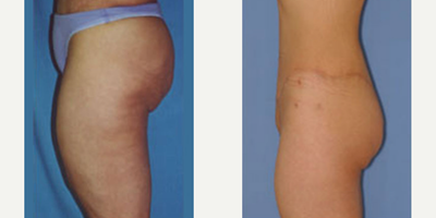 Woman treated with Body Lift - Lower Body Lift