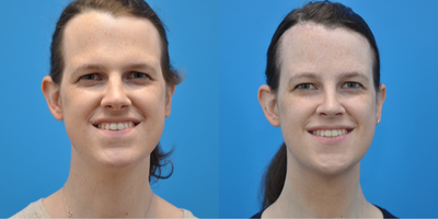 25-34 year old transgender woman treated with Facial Feminization Surgery, Transgender Facial Feminization Surgery, Brow Bone Re - This patient is a transgender female that underwent forehead reduction, brow bone reduction with sinus set back and orbital rim contouring, browlift, rhinoplasty, and shave genioplasty.
