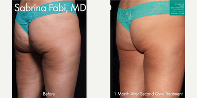 35-44 year old woman treated with Qwo - Qwo use to to treat cellulite on the buttocks of a female patient by Dr. Fabi.
