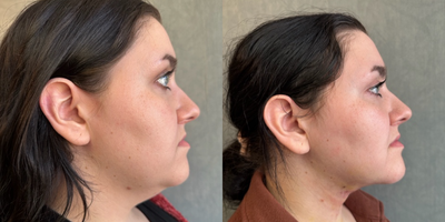 35-44 year old woman treated with Chin Liposuction - Chin Liposuction