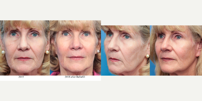 64 year old woman treated with Bellafill - One kit of Bellafill for facial rejuvenation.