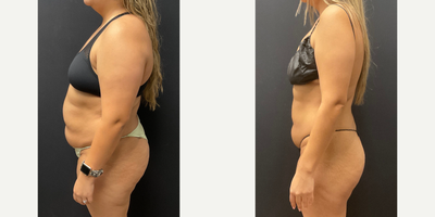 Woman treated with Semaglutide - Woman treated with Semaglutide