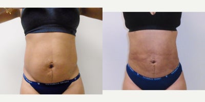 35-44 year old woman treated with Smart Lipo - 360 power assisted liposuction before and after