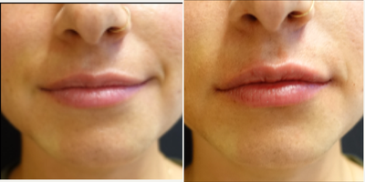 25-34 year old woman treated with Restylane Refyne - The patient had a lip augmentation with Restylane Refyne. A new product that has less swelling and lasts longer! All of my patients wish they had a lip filler that lasts longer and now they have more options. Restylane Refyne is a great product that lasts up to a year. It is designed for patients that want a product that will last longer but still give them a subtle yet lasting result for their lip augmentation.