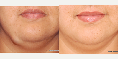 45-54 year old woman treated with Facial Reconstructive Surgery - Sebaceous cyst removalEpidermal inclusion cyst removalJaw mass removalCosmetic excisionStephen Weber MD, FACSWeber Facial Plastic SurgeryDenver, Colorado