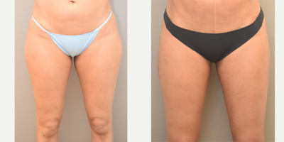 35-44 year old woman treated with SAFELipo - 41 yo lipo inner and outer thighs 6 months post op performed under local anesthesia with sedation in our on site certified operating suite