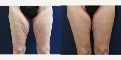 45-54 year old woman treated with Thigh Lift - Thigh Lift