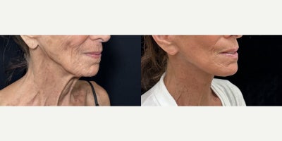 76 year old woman treated with Deep Plane Facelift, Neck Lift, Facial Fat Transfer, CO2 Laser - 76 year old woman treated with Deep Plane Facelift, Neck Lift, Facial Fat Transfer, CO2 Laser