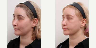 25-34 year old woman treated with Nonsurgical Facelift, AccuLift, Liposuction - Chief Complain: uneven face lines, hollowed under eyes, chubby cheeks, squared face shapeTreatment Plan: facial fat graft, under eye fat reposition, face liposuction ( cheeks, double chine, zygomatic angle) Outcome: - smooth V-lined face line - younger and refreshed look