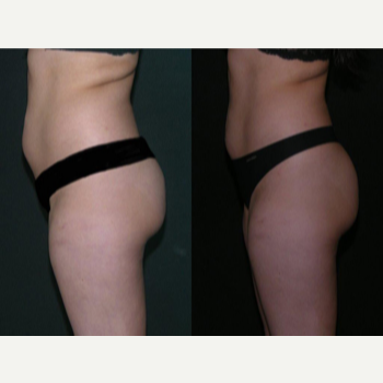 Zerona - Zerona total loss 8 inches.