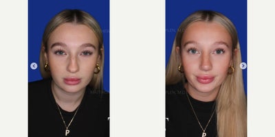 25-34 year old woman treated with Rhinoplasty - 25-34 year old woman treated with Rhinoplasty