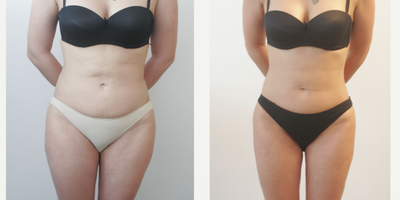 35-44 year old woman treated with Liposuction - Liposuction Surgery performed by DR. Ozge Ergun