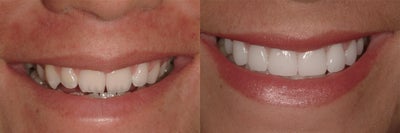Porcelain Veneers - Eight teeth enhanced with Durathin Prepless Veneers. No tooth reduction to create a lasting beautiful smile