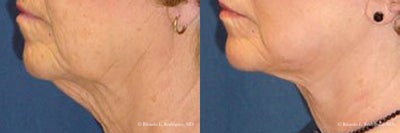 Neck lift - I performed a necklift procedure on this patient in her 70's. The surgery reduced the amount of extra skin on the neck, improving her profile.