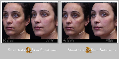 35-44 year old woman treated with Clear and Brilliant - Detailed knowledge of anatomy is essential to get the best outcome. As you see here her facial features after the treatments are well preserved and enhanced her beautiful face.