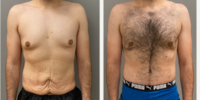 25-34 year old man treated with Gynecomastia Surgery, Male Tummy Tuck - 33 yo male s/p gynecomastia and male tummy tuck performed in our on site AAAA certified operating suite.