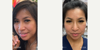 25-34 year old woman treated with Halo Laser, CO2 Laser, TCA Peel - Acne scars are a source of embarrassment and dejection for millions of people and our patient is no exception, unfortunately. However, she found us some time ago and has already seen remarkable improvement in her scars. This is her second treatment with us and she's hoping to further reduce the appearance of her scars so that she can feel more confident in herself. Using a combination treatment of TCA cross, Halo, and CO2 followed by a diligent EMER SKIN after-care routine, we were able to help her achieve utterly stunning results.No treatment is complete without EMER SKIN. Using our products post-treatment will enhance results to the absolute maximum.