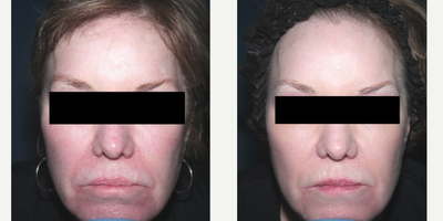 55-64 year old woman treated with Vivace - Vivace to full face