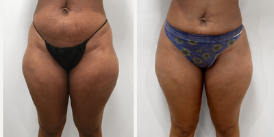 25-34 year old woman treated with Nonsurgical Butt Lift - The patient was treated with 10 syringes of Radiesse
