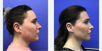 25-34 year old transgender woman treated with Forehead Reduction, Brow Lift, Septoplasty, Lip Lift, Lip Surgery, Adam's Apple Re - 25 to 34 year-old female patient is 1 year 1 month post-op from Facial Feminization surgery. Her procedures included: Forehead Lift, Hairline Lowering, Orbital Bony Contouring, Septorhinoplasty Revision (closed) with Cartilage Grafts, Chin Reduction and Contour, Intranasal Lip Lift, Thyroid Cartilage Shave Revision and Voice Feminization, Soft Tissue to Nasolabial Folds, 500 Micrografts to Hairline Recessions, 2 cc Voluma to Medial Cheeks, and 1 cc Juvederm to Lip Vermillion Bilaterally. Patient is 7 months post-op from 300 additional Micrografts to Hairline Recessions.