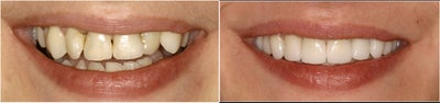 8 Veneers to a more confident smile - 
	Sometimes the decision for cosmetics is secondary to health.&nbsp; &quot;If you are going to fix my teeth, then you might as well make them pretty!&quot; is often spoken.

	This young woman had many decayed teeth.&nbsp; Some were not aligned in a pleasing way, so after 8 veneers she was able to smile much more confidently.

