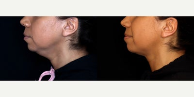 41 year old woman treated with Liposuction, PrecisionTx - 41 year old female treated with submental liposuction (Precision tx) Photos depict before and 6 months after surgery