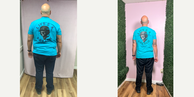 35-44 year old man treated with Endoscopic Sleeve Gastroplasty - She lost 81 LBS in 1 year after his Endoscopic Sleeve Gastroplasty Suture Sculpt weight loss procedure.