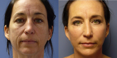 Woman treated with Eyelid Surgery - Woman treated with Extended SMAS Facelift as well as Neck Lift, Eyelid Surgery through upper blepharoplasty, and Facial Fat Transfer. Post-op, patient had an improved neck, jowls and cheek without any stigmata of a facelift.