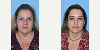 Woman treated with Neck Lift - Woman treated with Facelift, Neck Lift, and skin pinch.