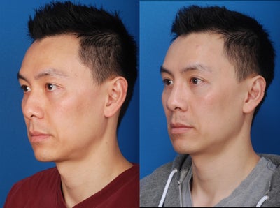 Asian Rhinoplasty - The patient desired augmentation along the bridge of the nose, refining of the nasal tip, and the use of non-synthetic implant materials. The patient underwent rhinoplasty with the use of native cartilage and fascia to eliminate any future concern of implant rejection or infection.