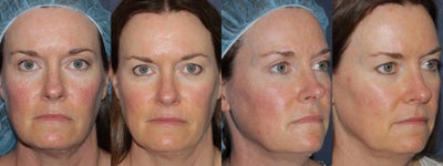 Before & After IPL - 
	Treated this patient with IPL photo facial procedure to reduce the appearance of rosacea and to improve other skin imperfections.
